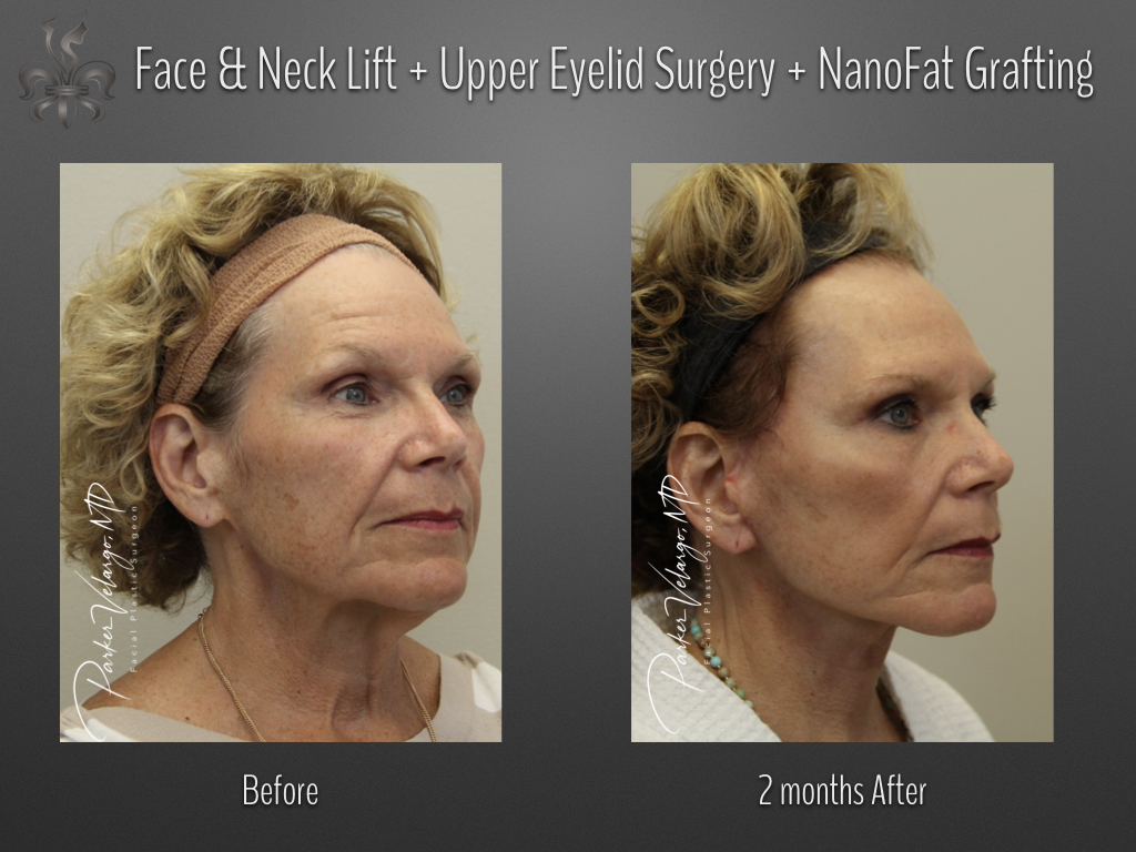 Face/Neck Lift before and after