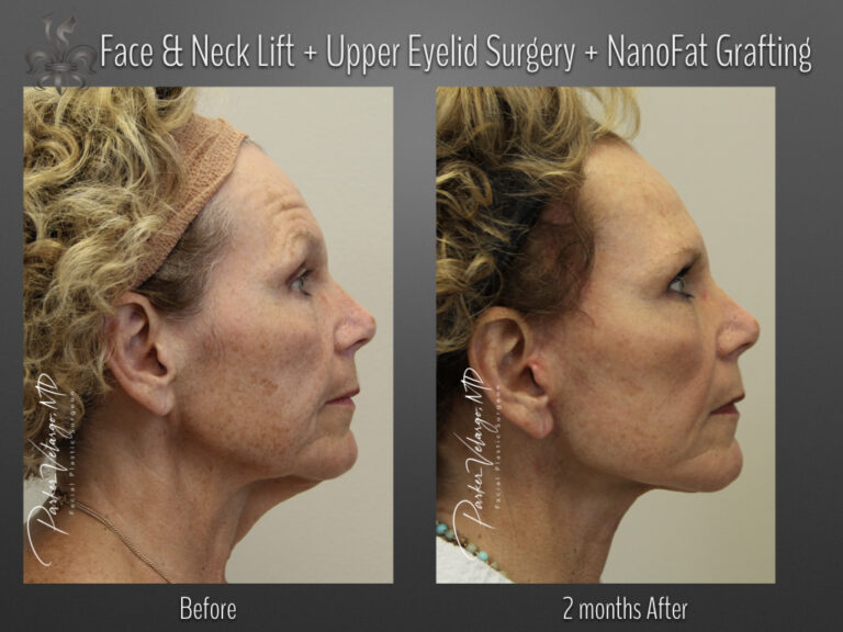 Face/Neck Lift before and after