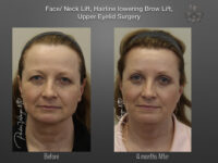 Face/Neck Lift before and after