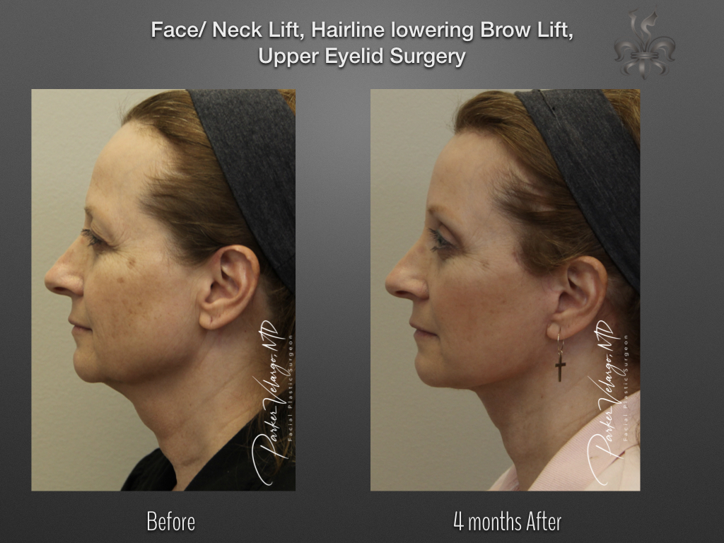 Face/Neck Lift before and after