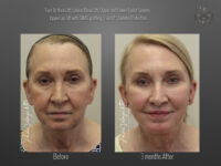 Face/Neck Lift before and after