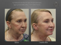 Face/Neck Lift before and after