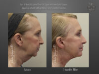 Face/Neck Lift before and after