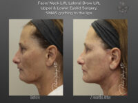Face/Neck Lift before and after