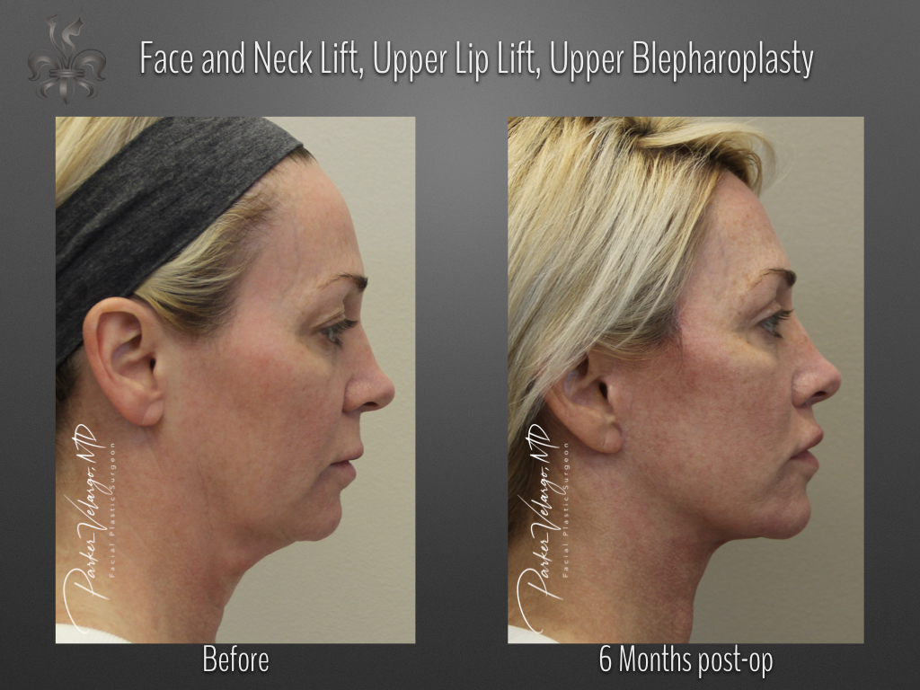 Face/Neck lift before and after