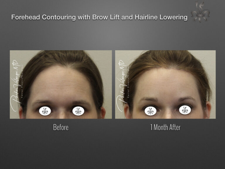 Facial Feminization before and after