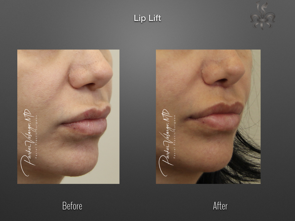 Lip Lift before and after