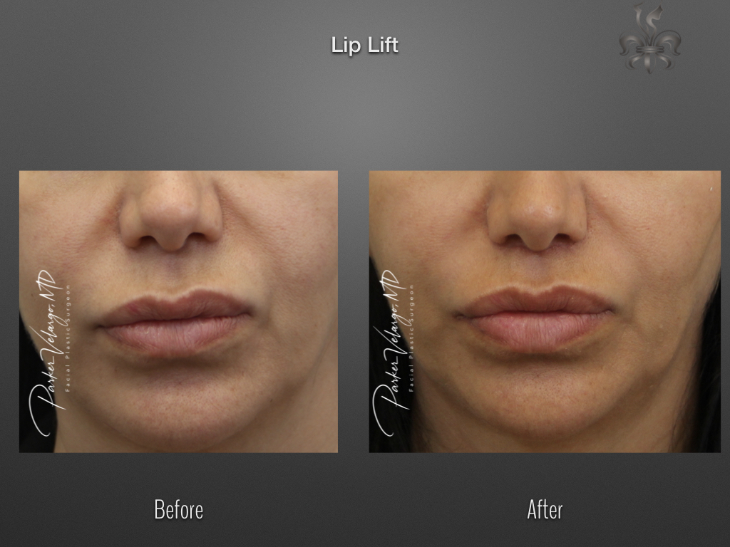 Lip Lift before and after