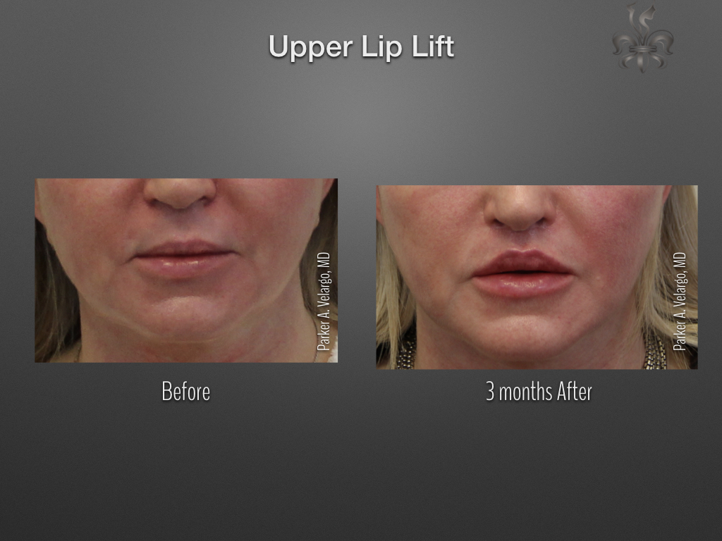 Lip Lift before and after