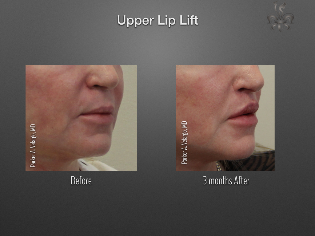 Lip Lift before and after