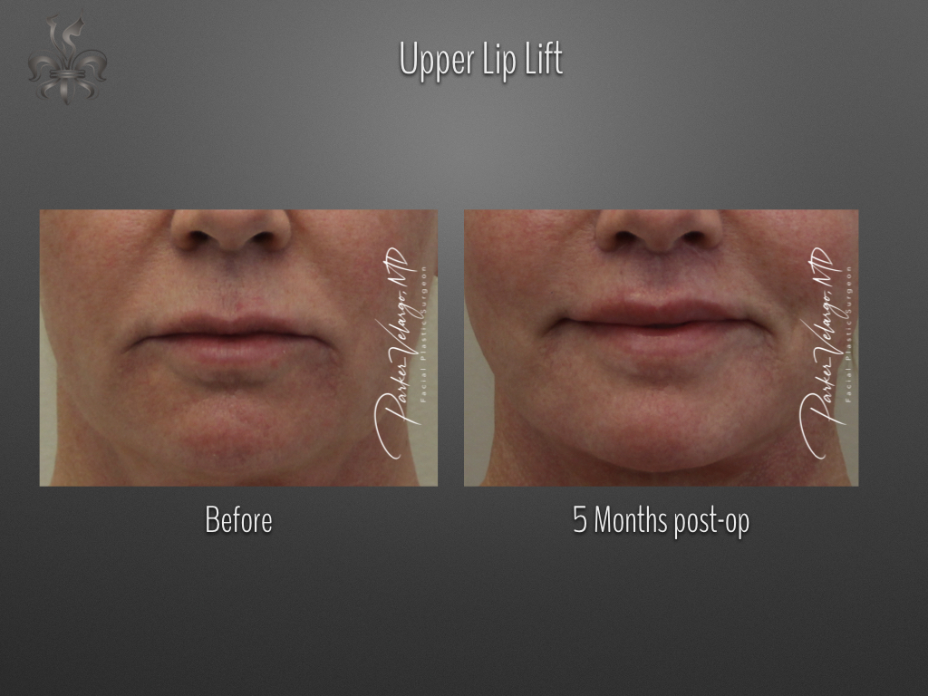 Lip Lift before and after