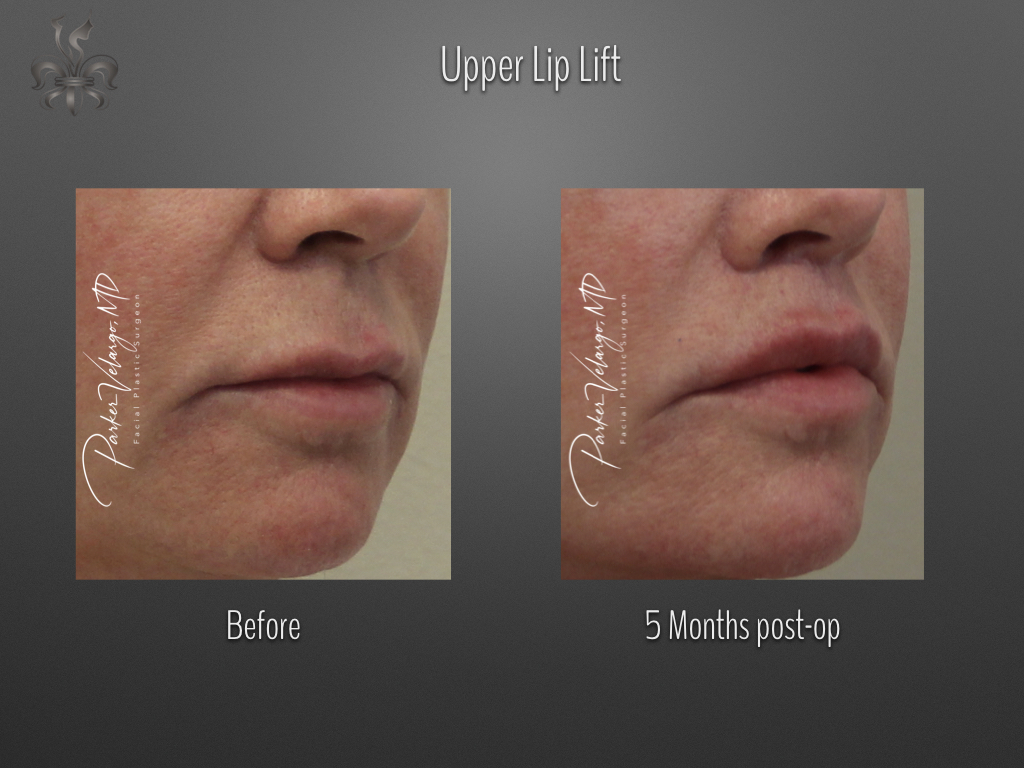 Lip Lift before and after