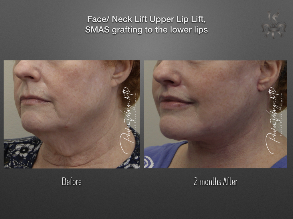 Lip Lift before and after