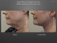 Lip Lift before and after