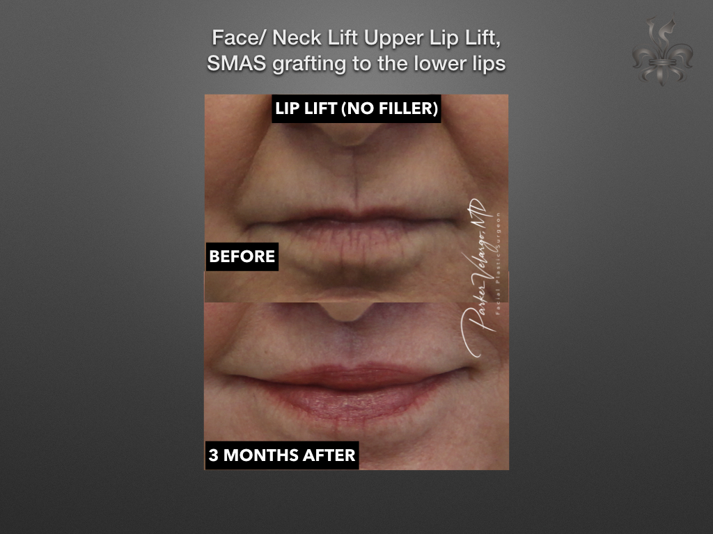 Lip lift before and after