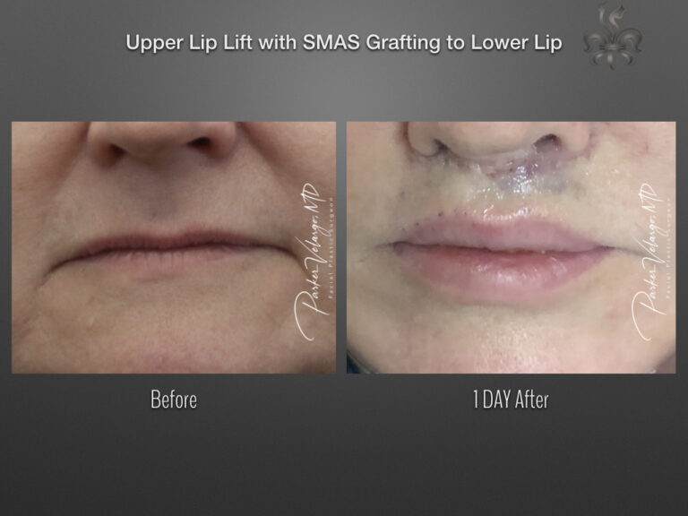 Lip lift before and after