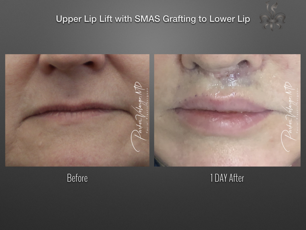 Lip lift before and after