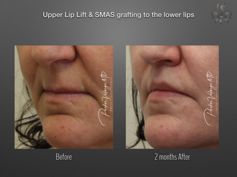 Lip lift before and after