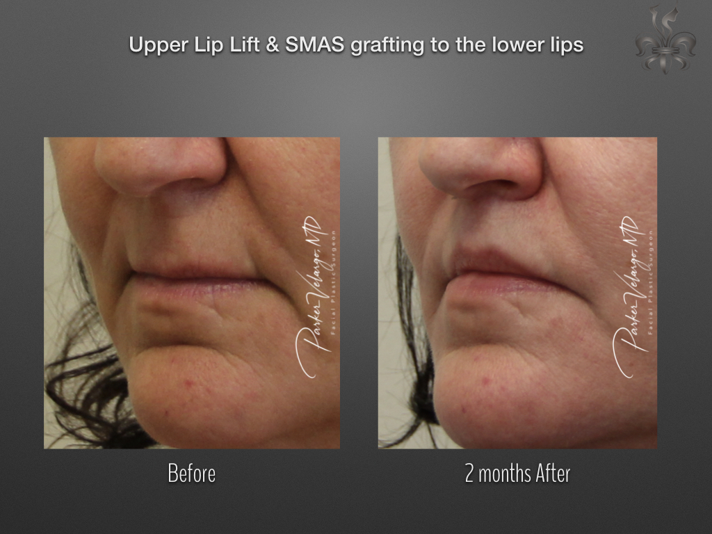 Lip lift before and after