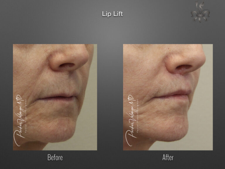 Lip lift before and after
