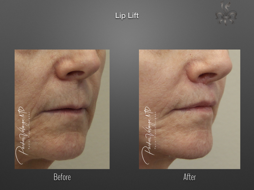 Lip lift before and after