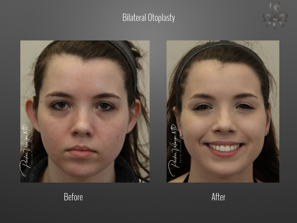 Otoplasty before and after