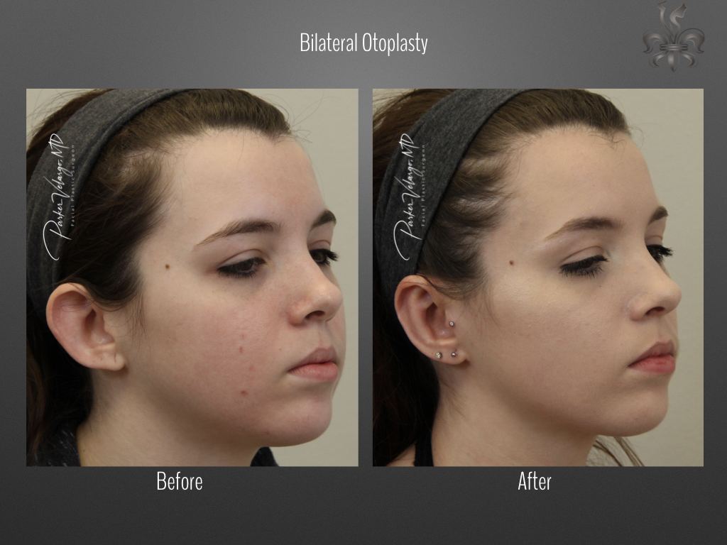 Otoplasty before and after