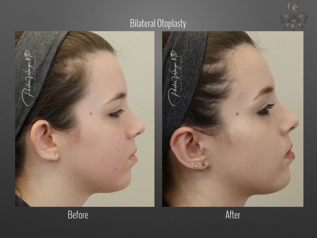 Otoplasty before and after