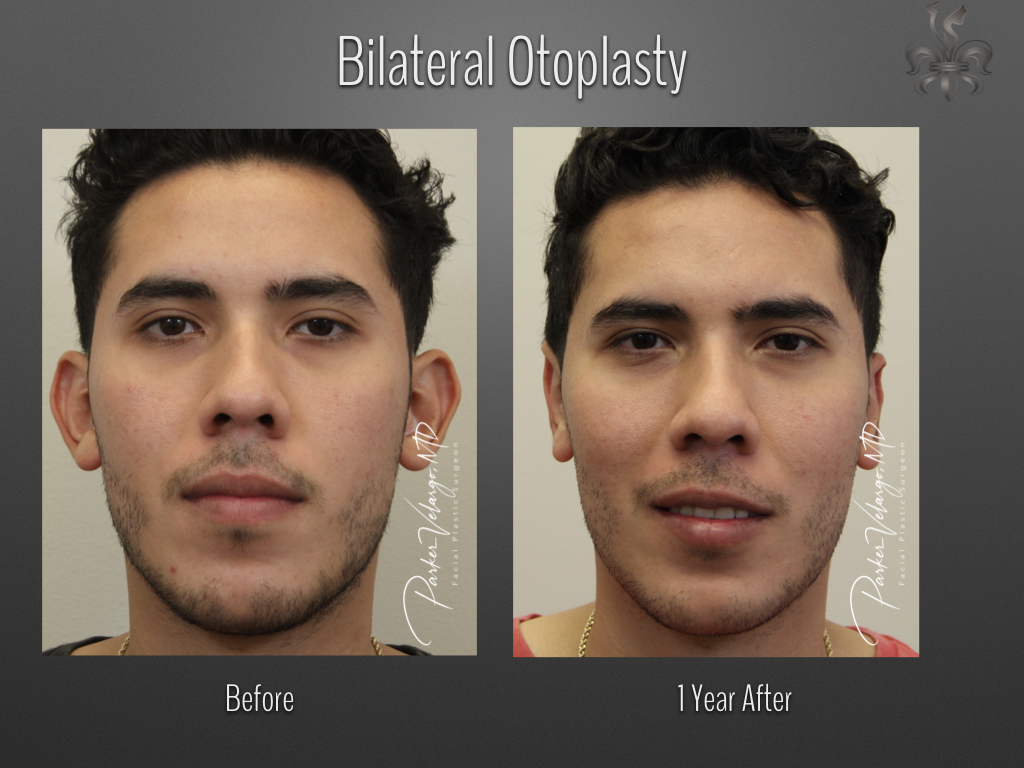 Otoplasty before and after