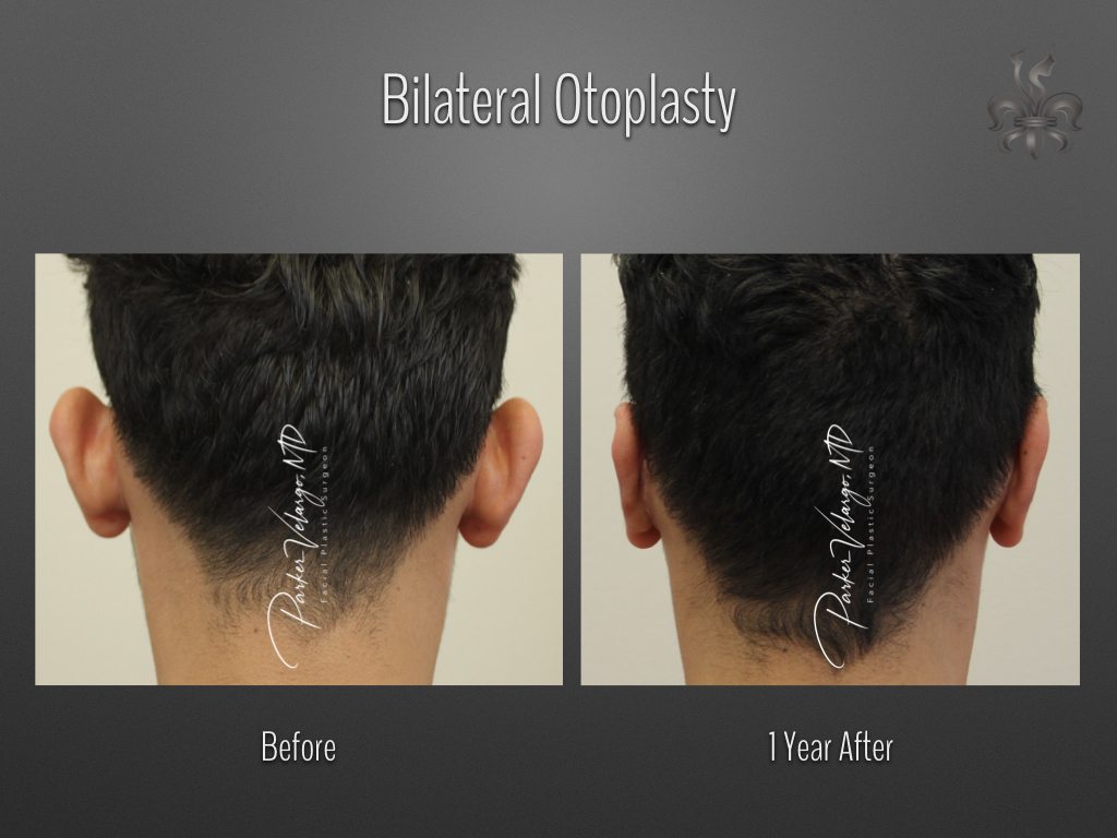 Otoplasty before and after