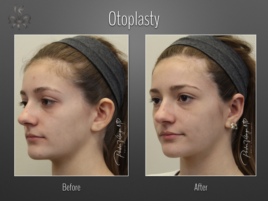 Otoplasty before and after