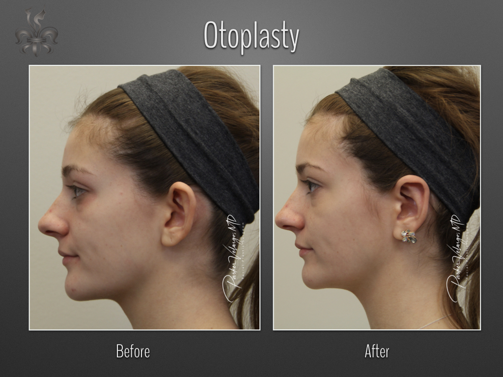 Otoplasty before and after