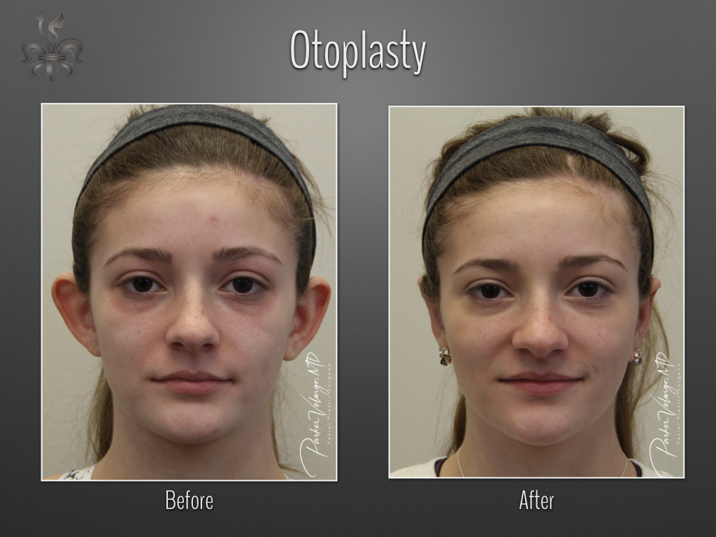 Otoplasty before and after