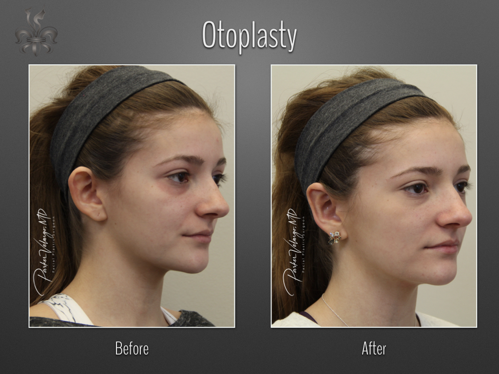 Otoplasty before and after