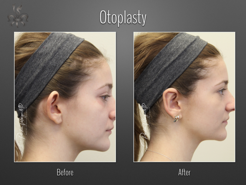 Otoplasty before and after