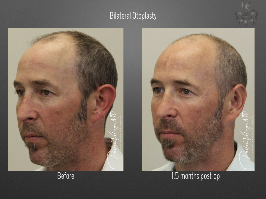 Otoplasty before and after
