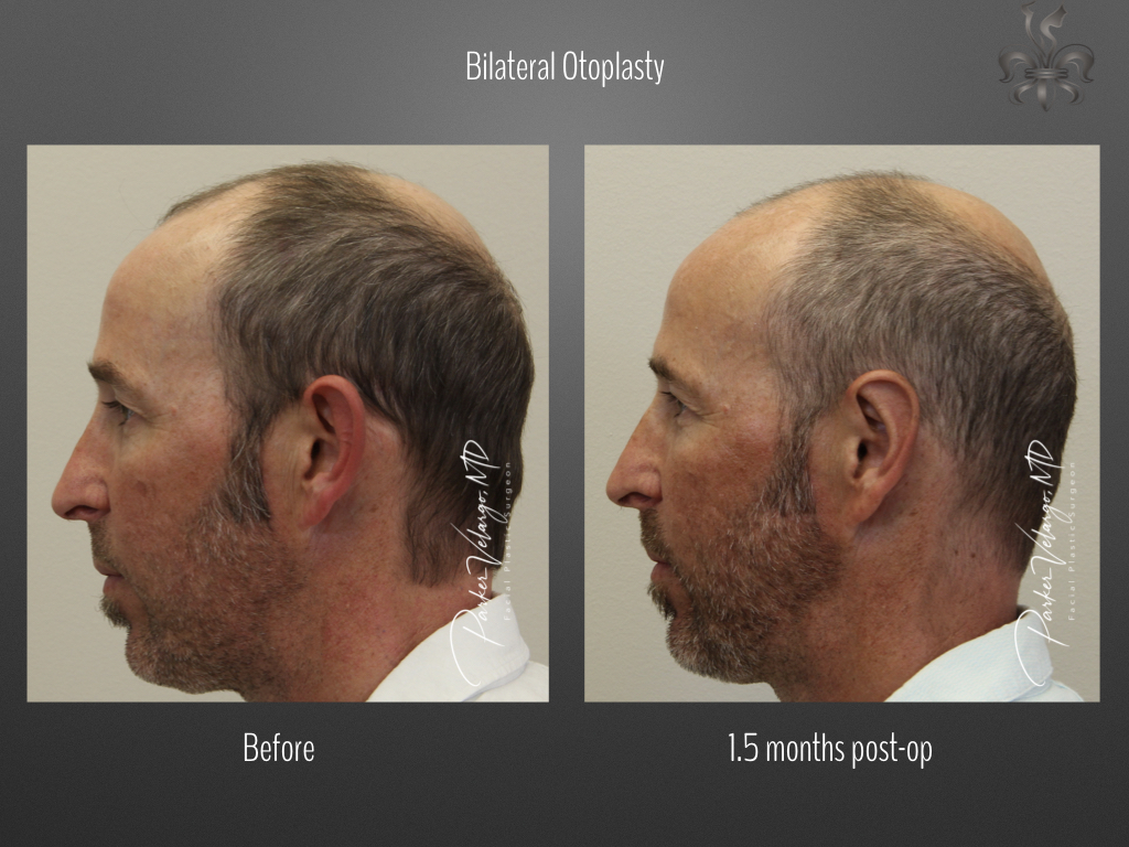 Otoplasty before and after