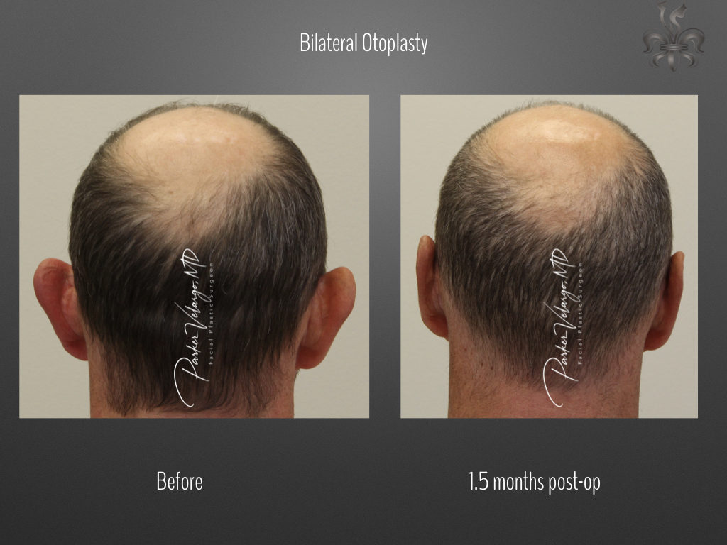 Otoplasty before and after