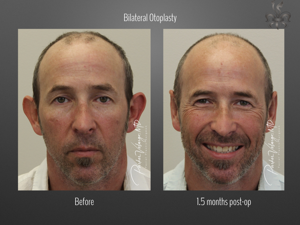 Otoplasty before and after