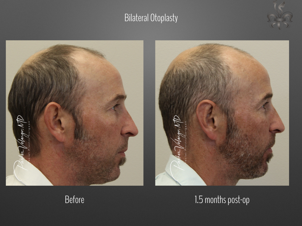 Rhinoplasty before and after