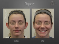 Otoplasty before and after