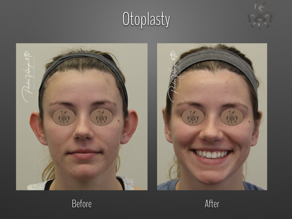 Otoplasty before and after