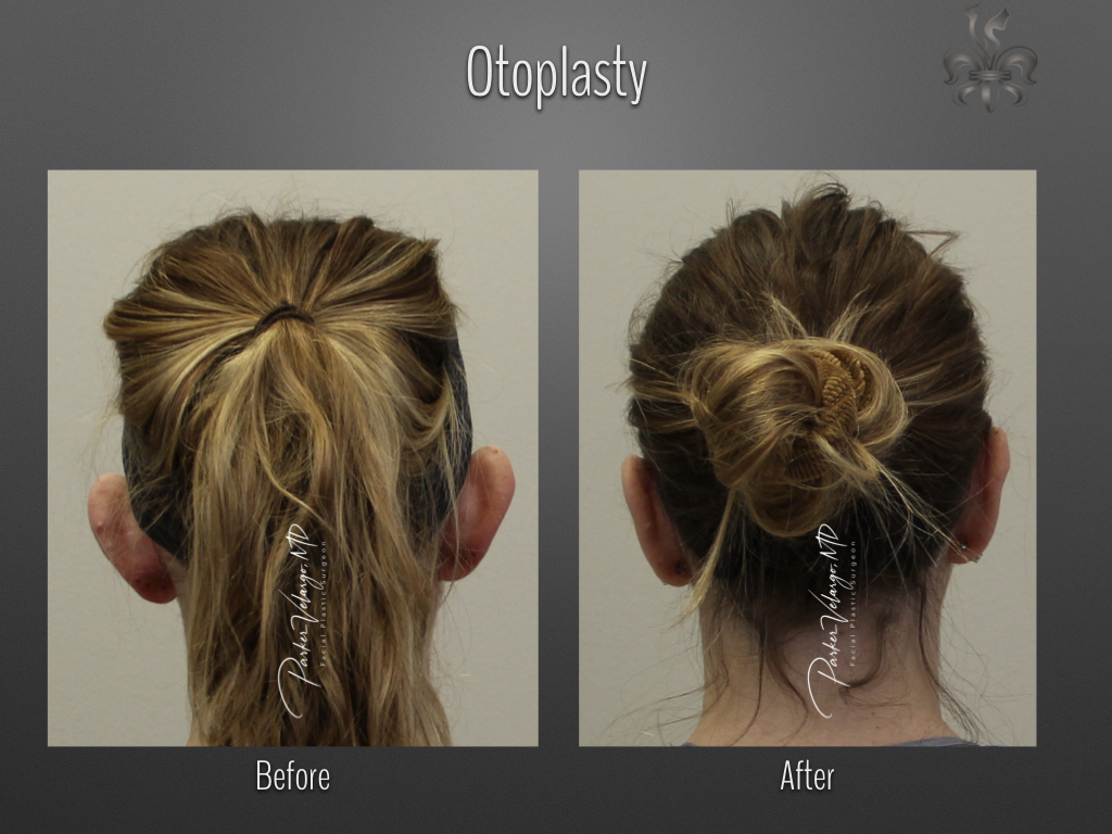 Otoplasty before and after
