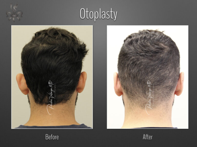 Otoplasty before and after