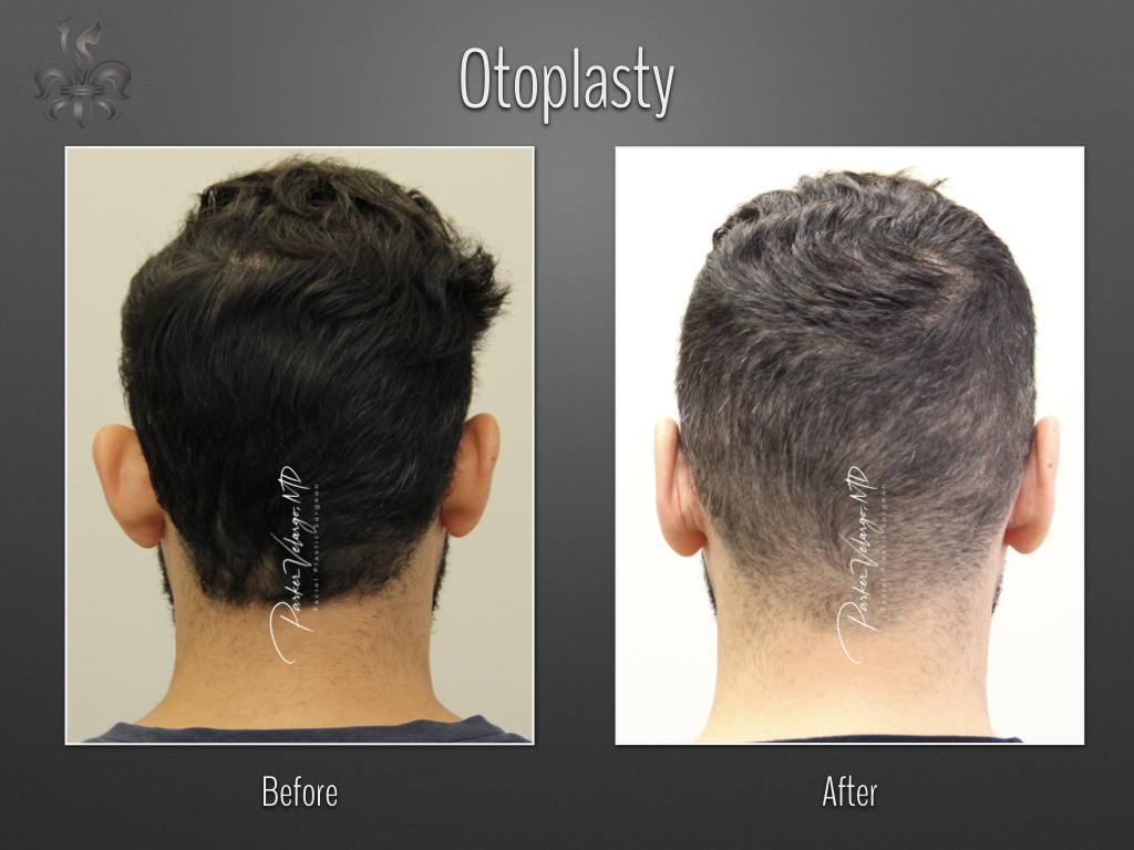 Otoplasty before and after