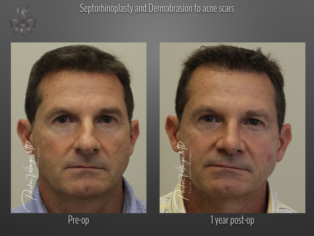 Rhinoplasty before and after