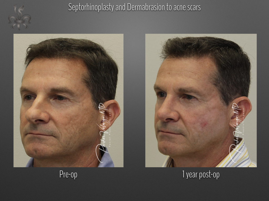 Rhinoplasty before and after
