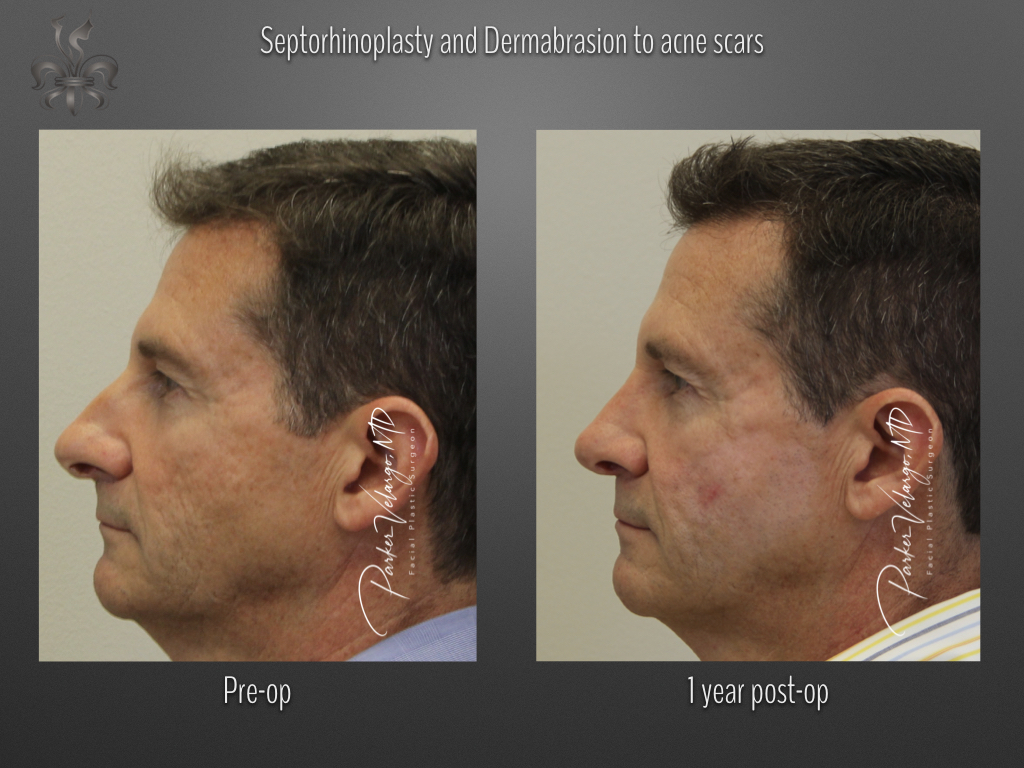 Rhinoplasty before and after