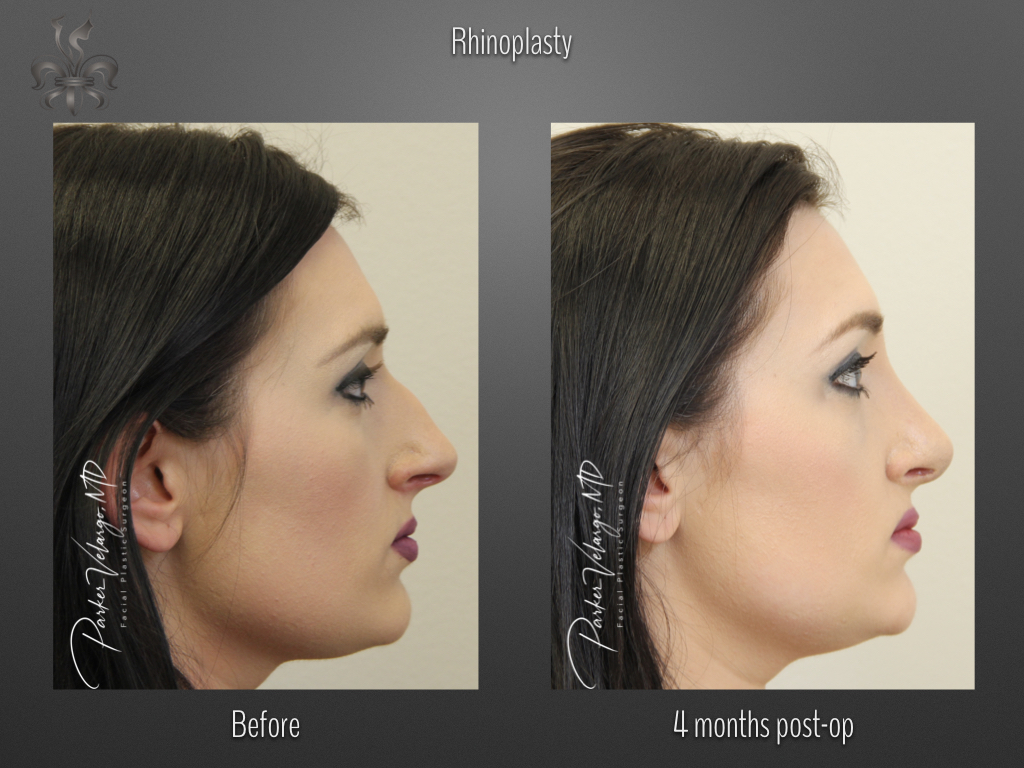 Rhinoplasty before and after