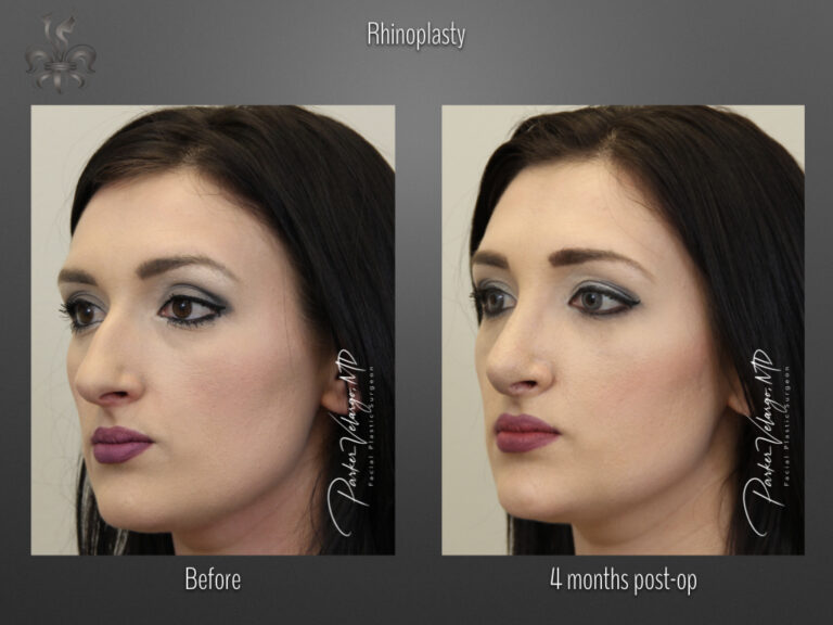 Rhinoplasty before and after